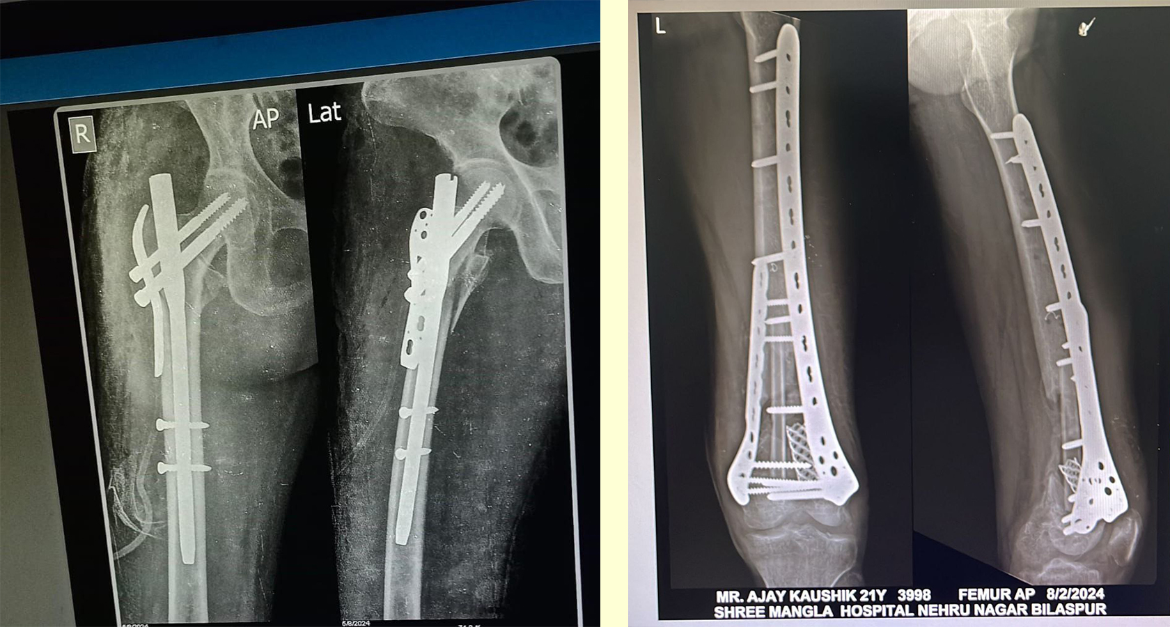 Advance Trauma and Pelvi Acetabular Surgery
